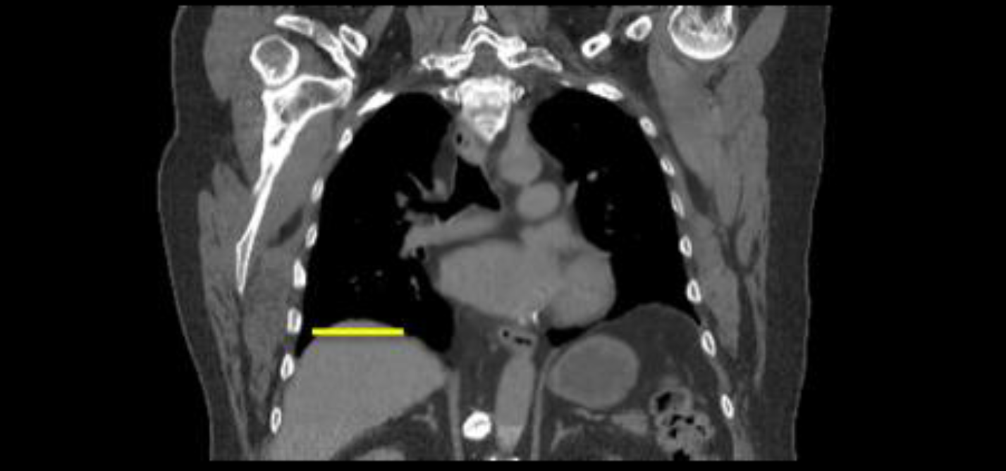 Connecting cardiac and respiratory 3DCT imaging for 5DCT heart motion