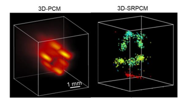 3D cavitation mapping to improve laser lithotripsy for the treatment of kidney stones