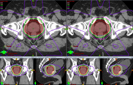 An example treatment planning system obtained from a 5-field 10 MV 3DCRT prostate cancer treatment plan. A first series of images (left) show the target (in red shaded region) and the associated radiation dose distribution (series of concentric solid lines representing different dose levels) for an actual 10 MV photon energy on the Linac. A second series of images (right) show the same region and associated dose distributions from the synthetically derived 10 MV plan. The almost identical concentric isodose lines demonstrate the very similar dose distributions (i.e., the radiation outcome) from these two treatment plans. Adapted from Figure 7 of US patent application 16/918, 779.