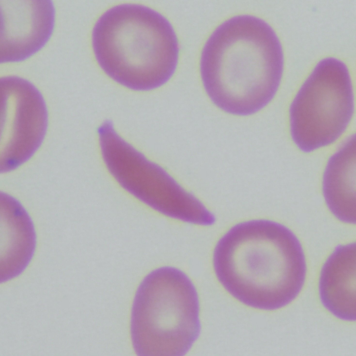 Photomicrograph of normal-shaped and sickle-shape red blood cells from a patient with sickle cell disease