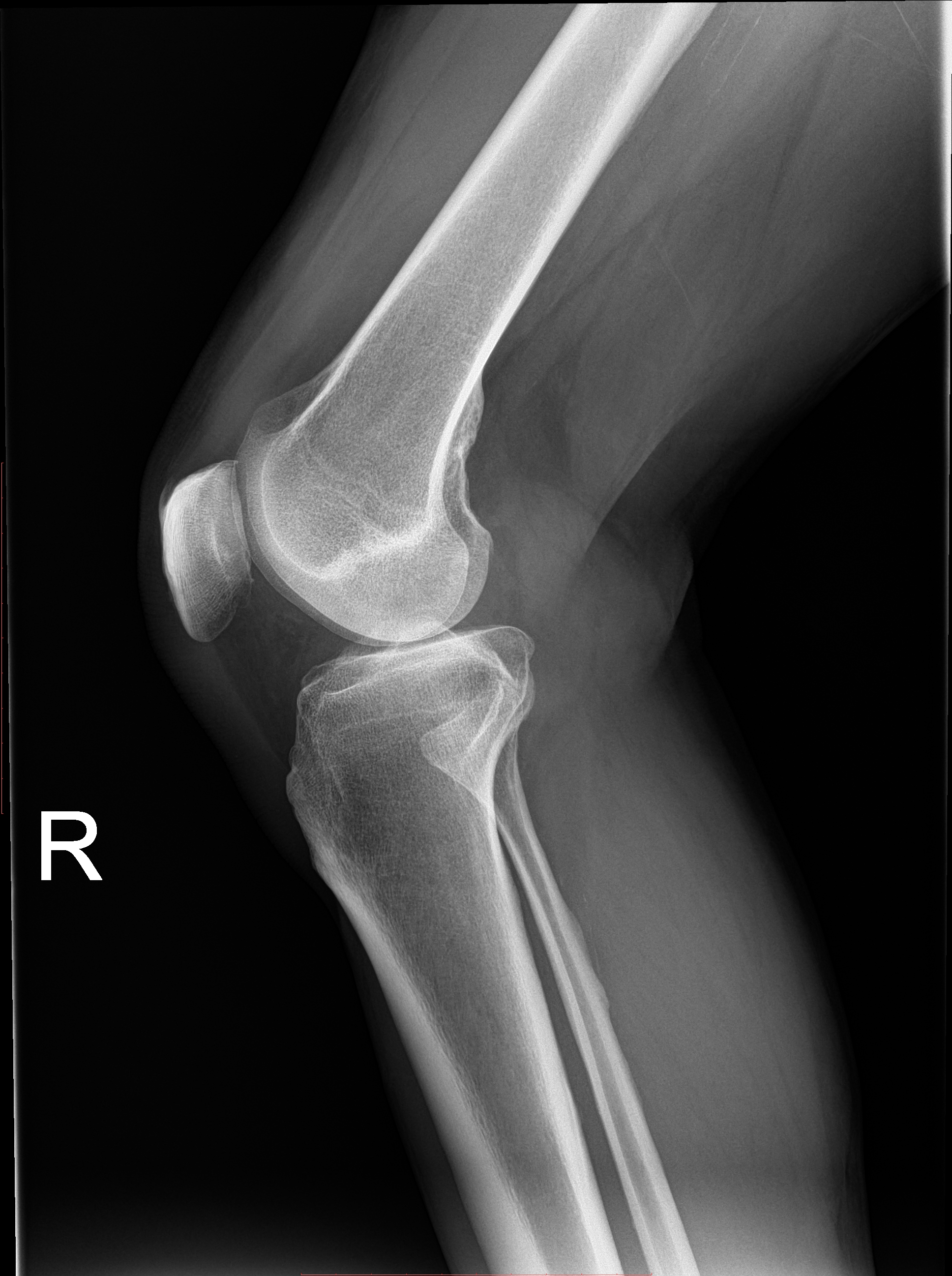 Right knee X-ray