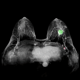 Magnetic resonance imaging-based tool to predict breast cancer recurrence
