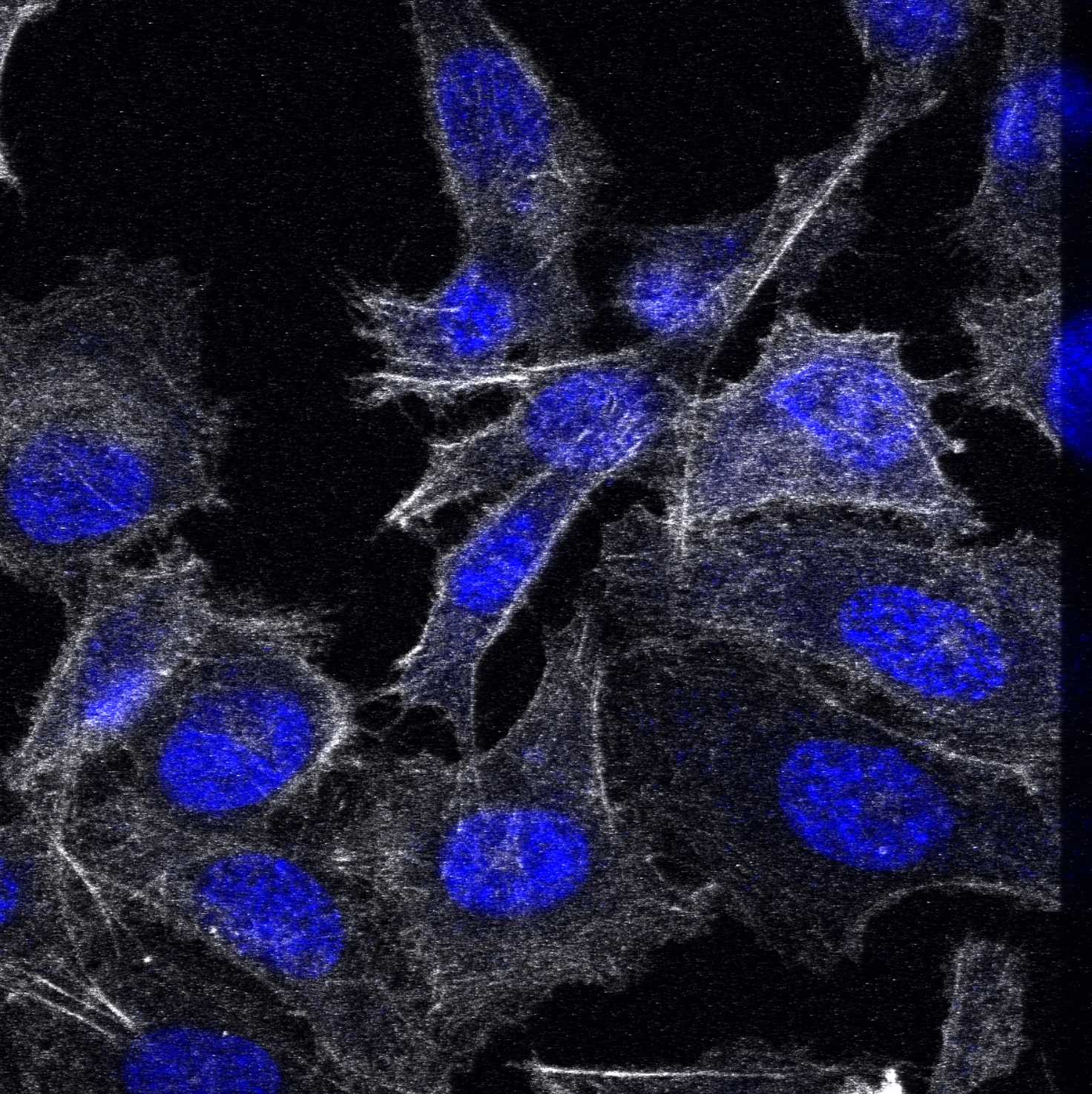 Prostate cancer cells under a confocal microscope. 