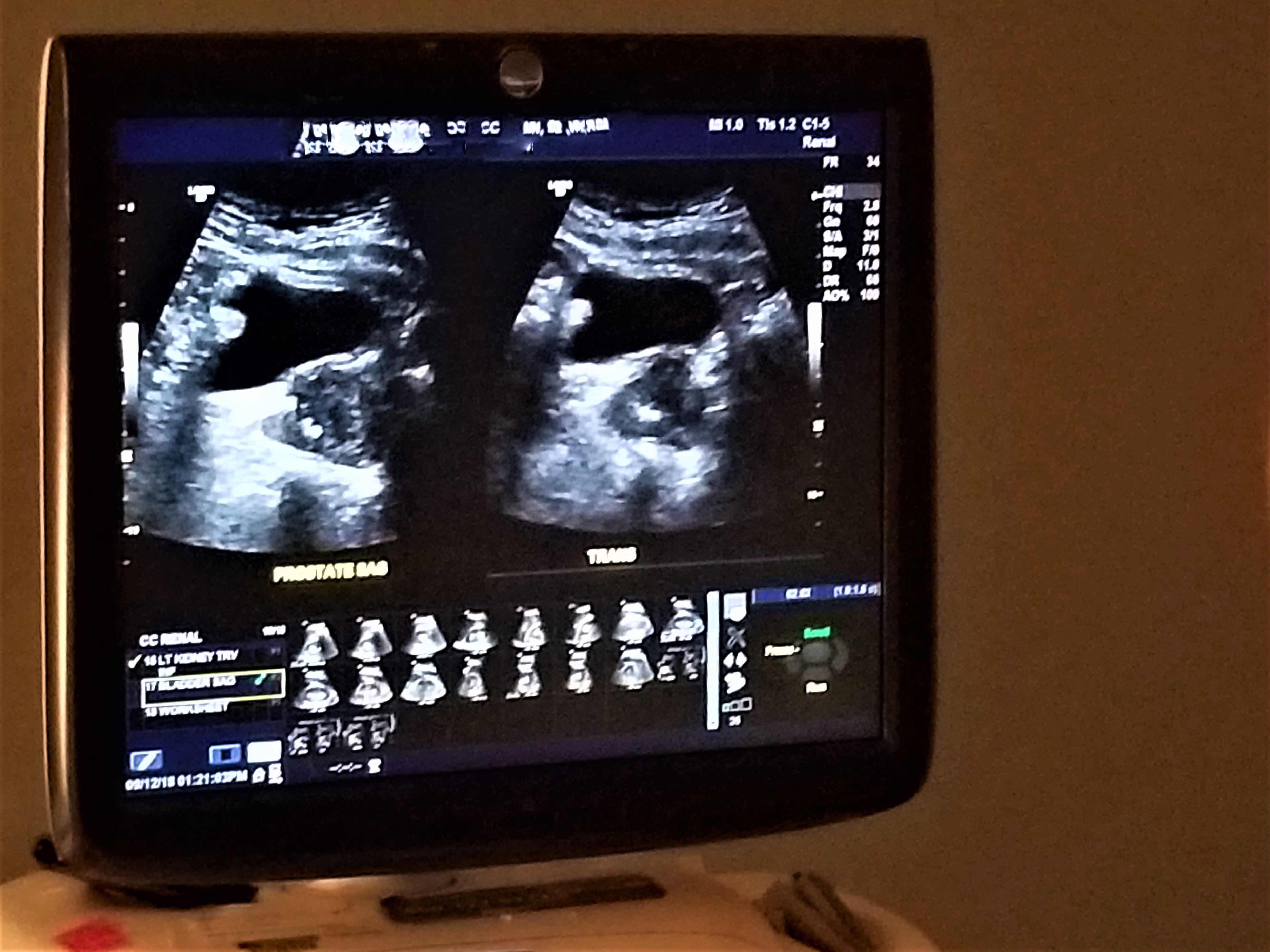 Ultrasound image of kidneys