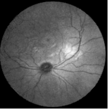 Example image of retina acquired with this technology. Adapted from Figure 7 of PCT Application US2020/038638.
