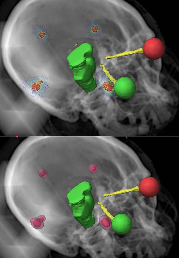 A system and method for planning radiosurgery treatments that can better target multiple tumors simultaneously