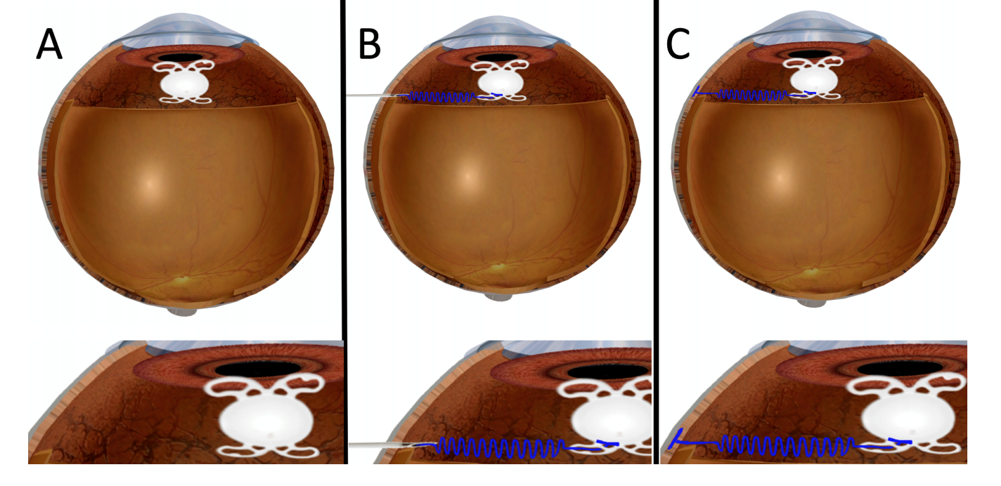 An intraocular lens is inserted into the eye in standard fashion (A). Similar to the technique for scleral sutured intraocular lens, a needle is passed at the appropriate location through the sclera. Unlike scleral sutured lenses that require a limited conjunctival peritomy, the MMFD may in certain instances be delivered without conjunctival peritomy. The tip of the MMFD delivery device is inserted through one or more holes in the intraocular lens and the distal fixation arm is deployed (B). The delivery device needle is further retracted until the proximal fixation arm opens beneath the conjunctiva but within or outside of the scleral wall (C). In certain instances limited peritomy with a scleral window are preferable and then the proximal fixation arm opens within the scleral window pocket. The scleral window is then glued or sutured into place and the conjunctiva is closed.    Adapted from Figure 8 of US patent application 17/109,919.