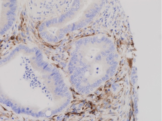 Immunohistochemical staining of colorectal carcinoma. Created by Enzymlogic and is licensed with CC BY-SA 2.0. To view a copy of this license, visit https://creativecommons.org/licenses/by-sa/2.0/