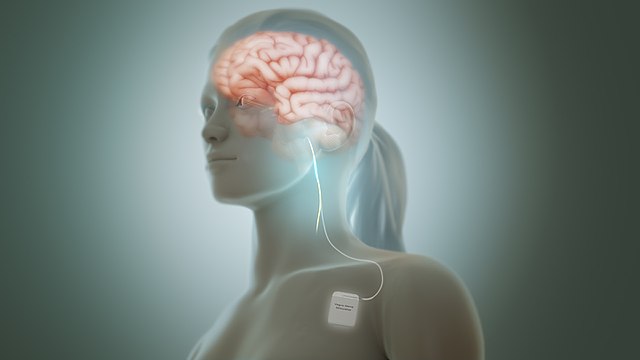 Schematics of a vagus nerve stimulation device on a woman (Source: Manu5 via Wikimedia. This file is licensed under the Creative Commons Attribution-Share Alike 4.0 International license.)