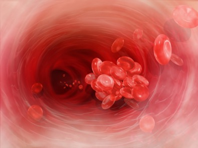 Illustration of intravascular view of blood clot forming from red blood cells. Image License: This file is licensed under the Creative Commons Attribution-Share Alike 4.0 International license. Source: https://commons.wikimedia.org/wiki/File:Blood-clot1.jpg