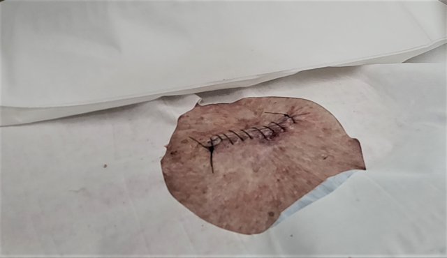 A sutured surgical incision (Source: Envato)