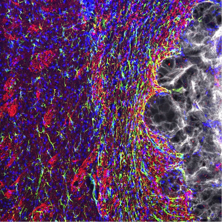 The image shows hydrogel that was injected into the stroke core. Axonal filaments are shown in red, astrocytes are dyed green, nuclei appear blue and the hydrogel is white. (Credit: Elias Sideris, https://doi.org/10.1101/768291)