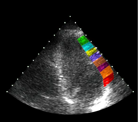 High frame rate ultrasound image of the heart, with propagating contractions highlighted (source: inventor)